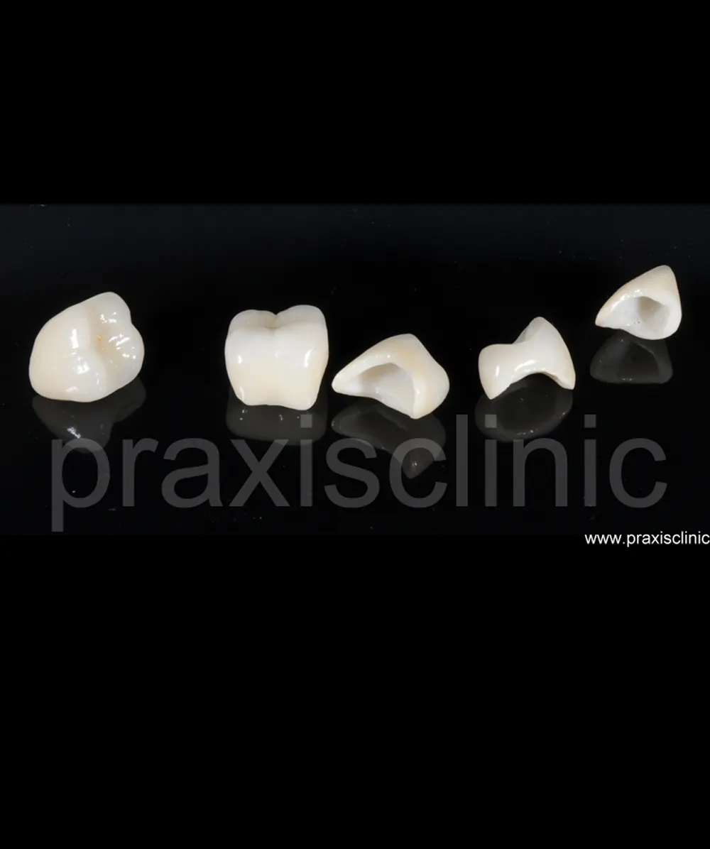 Dental crowns before and after - best dentist for dental crowns Mumbai Andheri Vile Parle PRAXIS Dental
